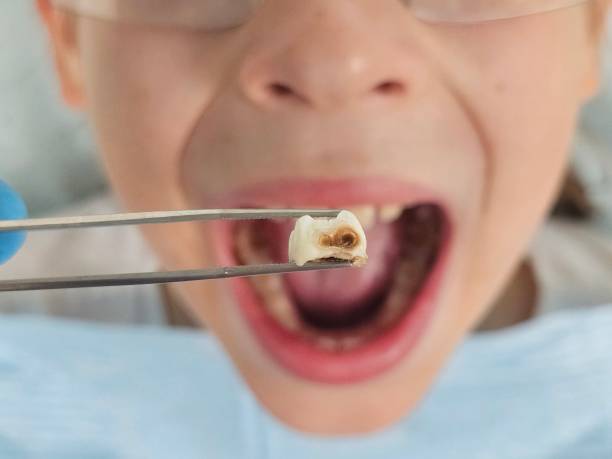 Best Pediatric Emergency Dentist in Bluefield, VA